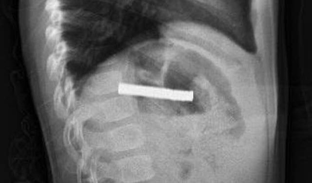 Elazığ’da 3 Yaşındaki Çocuğun Boğazından 19 Mıknatıs Çıkarıldı